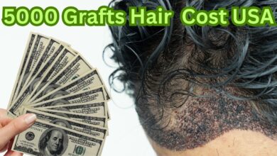 5000 Grafts Hair Transplant Cost in the USA